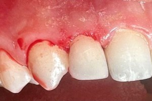 Tooth with exposed root and inflamed gum tissue