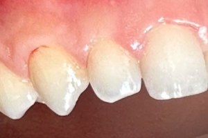 Chipped front tooth needing restoration