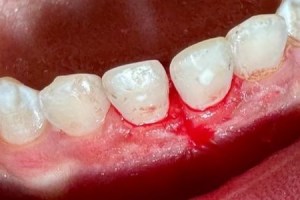 Gum inflammation around lower front teeth