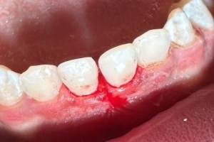 Bleeding gum between upper front teeth