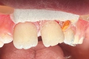 Upper front teeth with dental dam in place, showing a small orange filling on one tooth and minor enamel wear.