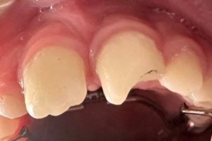 Close-up of upper front teeth showing chipped enamel and dental braces on lower teeth.