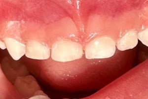 Crowded lower front teeth with overlapping alignment
