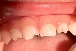 Worn and uneven incisal edges of front teeth