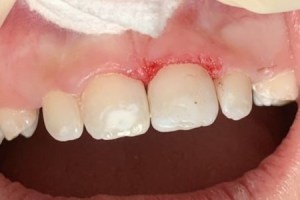 Gum tissue healing after dental procedure or extraction