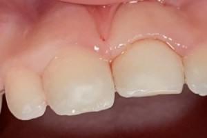 Smooth, restored front teeth after cosmetic treatment
