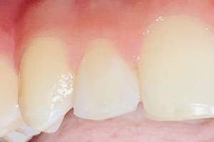 Bright, even front teeth after whitening or veneer placement