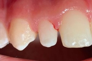Chipped central incisor needing repair or bonding