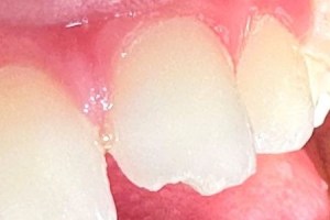 Close-up of a chipped front tooth with smooth edges and healthy pink gums surrounding it.