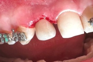 Tooth extraction site with healing gum tissue and adjacent braces