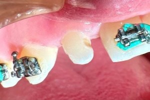 Braces with blue ligatures on upper teeth — orthodontic treatment in progress