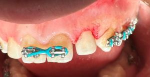Upper arch with braces showing gum inflammation near extraction site