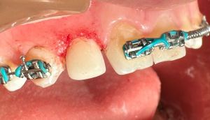 Braces with turquoise ligatures on upper teeth — active orthodontic adjustment