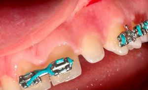 Close-up of bracket and wire on lower front tooth — precise alignment in progress