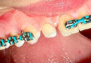 Close-up of braces with turquoise brackets on upper arch