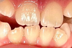 Close-up of upper and lower front teeth with natural translucency and slight surface wear.