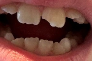 Open mouth view showing upper front teeth with a noticeable chip and mild crowding.