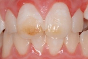 Upper front tooth with small brown stain or early cavity near the gumline; adjacent teeth appear healthy.