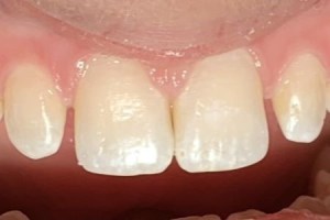 Smooth, natural-looking front teeth after cosmetic restoration
