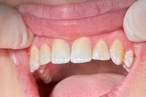 Patient’s smile showing slightly uneven but healthy front teeth