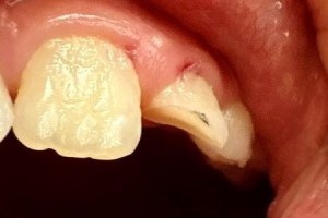 Side view of molar and adjacent tooth with visible decay and gum inflammation nearby.