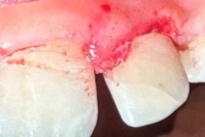 Fresh dental incision near gumline with minor bleeding; adjacent teeth appear intact.