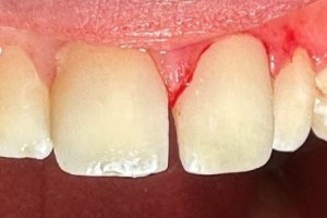 Two upper front teeth with minor chips and surface wear; gums appear slightly red and irritated.