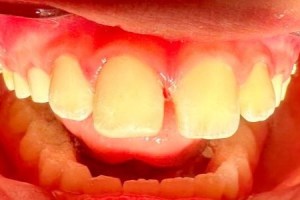 Severe gum inflammation with red, swollen gums and yellowish plaque buildup on teeth.
