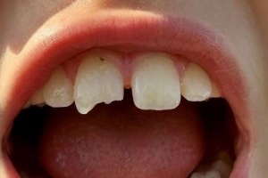 Child’s open mouth showing chipped upper front tooth and slightly uneven alignment.