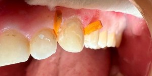 Upper teeth with temporary orange dental material placed between two teeth during treatment.