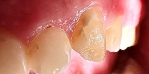Close-up of a broken molar with jagged edges and surrounding healthy gum tissue.