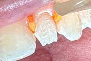 Tooth preparation for crown with orange dental dam in place
