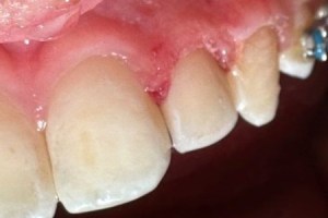 Inflamed gum tissue around upper front teeth — signs of gingivitis or periodontal issue