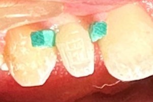 Braces with green ligatures on upper front teeth — orthodontic alignment in progress