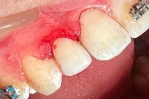 Severely inflamed and bleeding gums around a tooth.