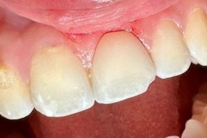 Close-up of upper front teeth with mild staining and slight gum inflammation along the gumline.