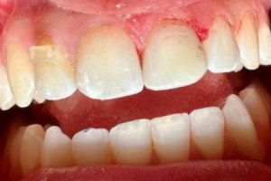 Full view of upper and lower teeth showing uneven alignment, discoloration, and red, swollen gums.