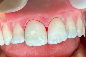 Upper front teeth after cosmetic treatment — smooth, bright, and evenly aligned.