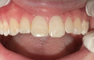 Upper front tooth after cleaning